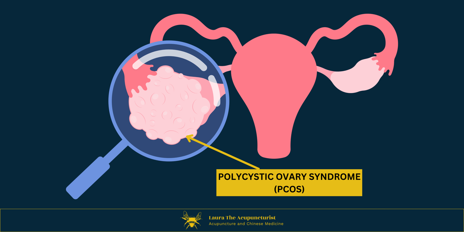 Polycystic Ovarian Syndrome (PCOS) and Thyroid Dysfunction
